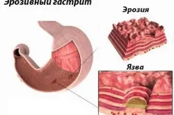 Заболявания на симптомите на стомаха и лечение, диета (снимка)