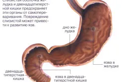 Betegségei a gyomor tünetek és a kezelés, étrend (fotó)