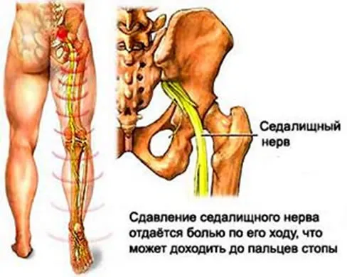 А ощипа нерв в симптомите на краката си и лечение