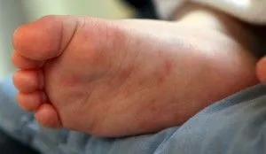 Сверблячка долонь і ступень (долонь) Сверблячка долонь і ступень
