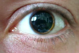 Pupillái, két tanuló, egy nagyobb, mint a másik oka a szem és a látás
