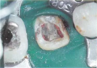 Durerea 04 după tratament endodontic și canalul de umplere