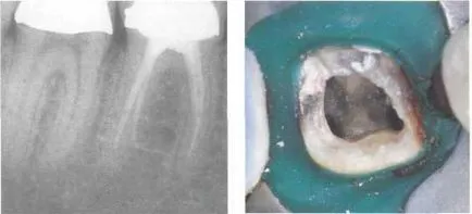 Durerea 04 după tratament endodontic și canalul de umplere