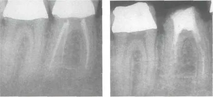 Durerea 04 după tratament endodontic și canalul de umplere