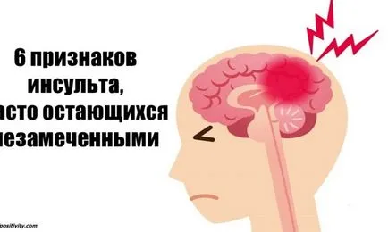 6 Semne ale unui accident vascular cerebral, toate acestea sunt ignorate - Info Sanatate