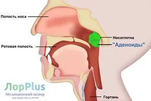 Adenotomija - o intervenție chirurgicală pentru a elimina adenoids