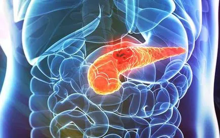 Adenocarcinoma a tünetek, diagnózis, kezelés, típusai