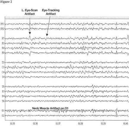 Agyi aktivitás és kvantitatív EEG