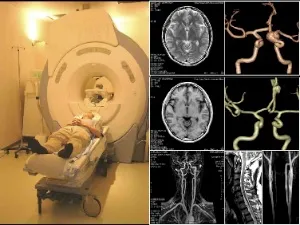 anevrism cerebral semne de patologie, diagnostic