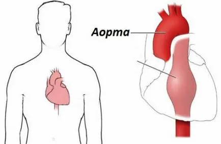 Аортна аневризма симптоми, диагностика и лечение