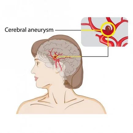 agyi aneurysmák