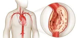 Atherosclerosis az aorta a szív okoz, tünetek és a kezelés