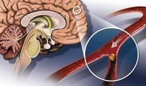 Tratamentul aterosclerozei cerebrală de droguri
