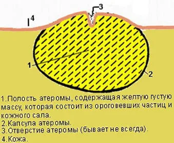 Атером причини за