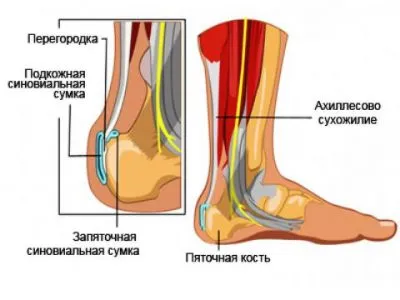 Retrocalcaneobursitis simptome glezna si tratament, este