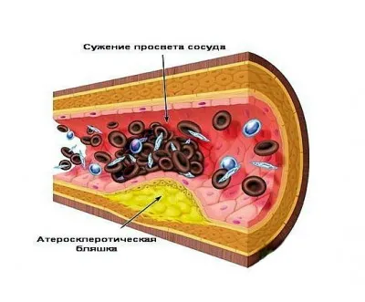 Артеросклероза на долните крайници, симптоми и лечение