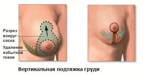 Мастектомія показання, ускладнення і підтяжка грудей (мастектомія) Мастектомія показання, ускладнення і підтяжка грудей