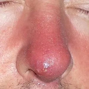 Възпаление на носа, когато се натисне вътре защо болка и се изчерви