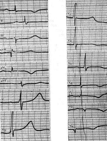 Durere în infarctul miocardic - tratament de inima