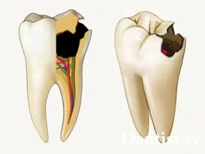 Durere de dinți, după umplerea canalelor care fac, cauze si tratament