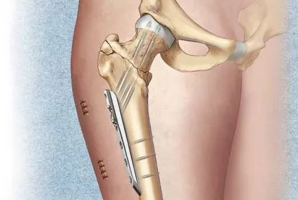 Tratamentul Transtrochanteric fractura de sold si reabilitare