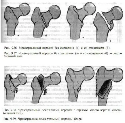 Tratamentul Transtrochanteric fractura de sold si reabilitare