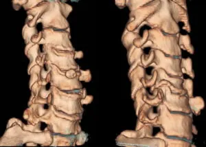 Care este tratamentul coloanei vertebrale epidurit purulente epidurita, spondylodiscitis