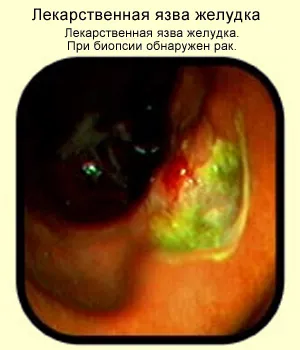 Ce este un drog ulcer