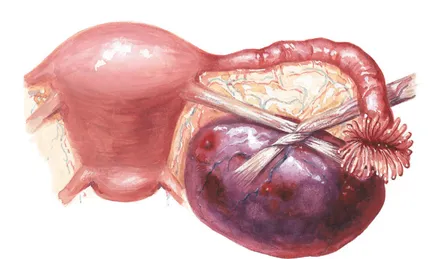 Dermoid cauze chist ovarian, tratament, dacă este necesar de funcționare și alte aspecte ale fotografiei