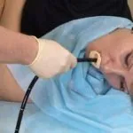 Distală esofagita de reflux, wiki esofag