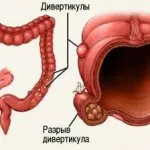 Диагноза - преплитане на червата симптоми и лечение