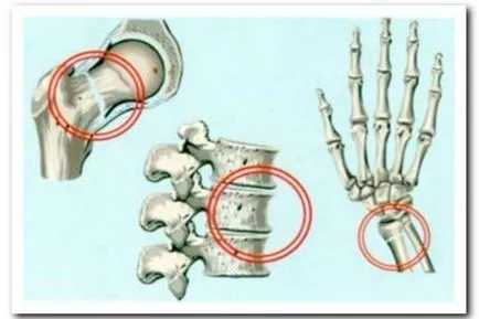 osteoporoză difuză a coloanei vertebrale, oase, picioare