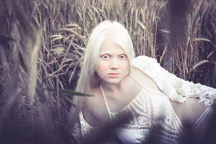 Albino lány „szülők gyermekkora óta azt mondták, hogy én vagyok egyedülálló”
