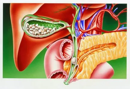 Dieta la o colecistită cum pentru a calma inflamație a vezicii biliare - trăi sănătos