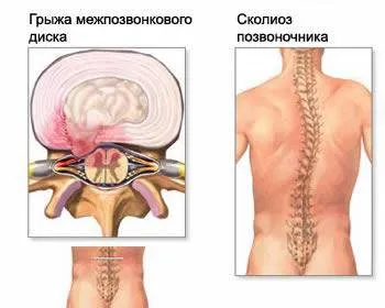 Ефективните методи за диагностика и лечение на междупрешленните херния