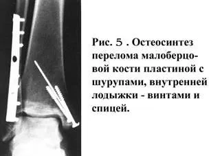 Методи лікування в травматології і ортопедії (постійного скелетного витягування) Методи лікування в травматології і ортопедії