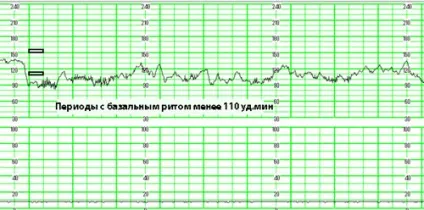 Медикаментозне лікування синусової брадикардії (брадикардії) Медикаментозне лікування синусової брадикардії