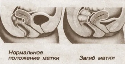 Матка вкінці при вагітності на ранніх термінах (матки Загин матки) Матка вкінці при вагітності на ранніх термінах