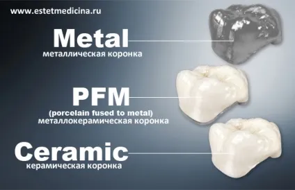 Металокерамічні або керамічні коронки відгуки, ціни, інтернет-журнал (кераміка для зубів відгуки) Металокерамічні або керамічні коронки відгуки, ціни, інтернет-журнал