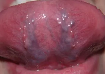 Purple език или лице под него - снимка, води, третиране