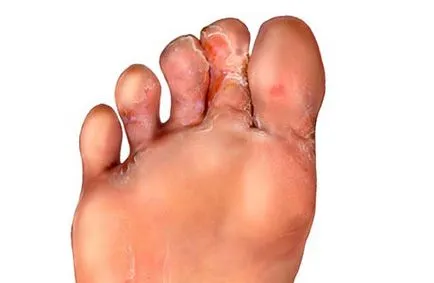 Gombák a lábujjak között kezelésére