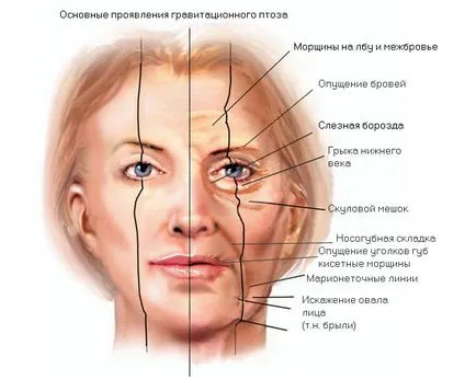 Ptoza gravitational măsură față a modificărilor și a metodelor de corecție