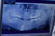 Зъбните импланти София - швейцарска клиника по имплантология