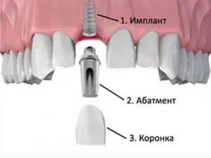 Fogászati ​​implantátumok kulcsrakész - mi ez, költség, ár-összehasonlító