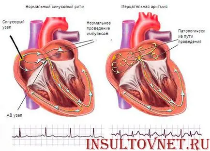 Un accident vascular cerebral în vârstă și caracteristicile de recuperare