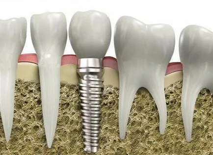 A fogászati ​​implantátum egylépéses olvasmányok és vélemények