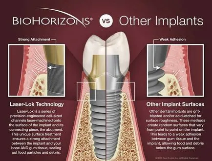 Az implantátumok biohorizons (biohorizons) típusok és előnyök