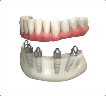 implantátumok biohorizons