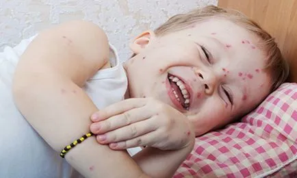 Pe măsură ce eliminați mancarime de varicela la copii