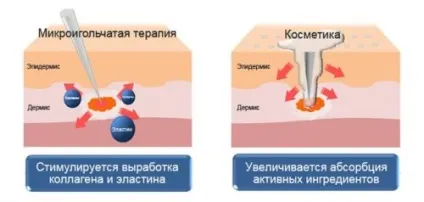 Мезороллер для волосся як користуватися, протипоказання і відгуки (протипоказання) Мезороллер для волосся як користуватися, протипоказання і відгуки